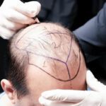 hair transplant-5