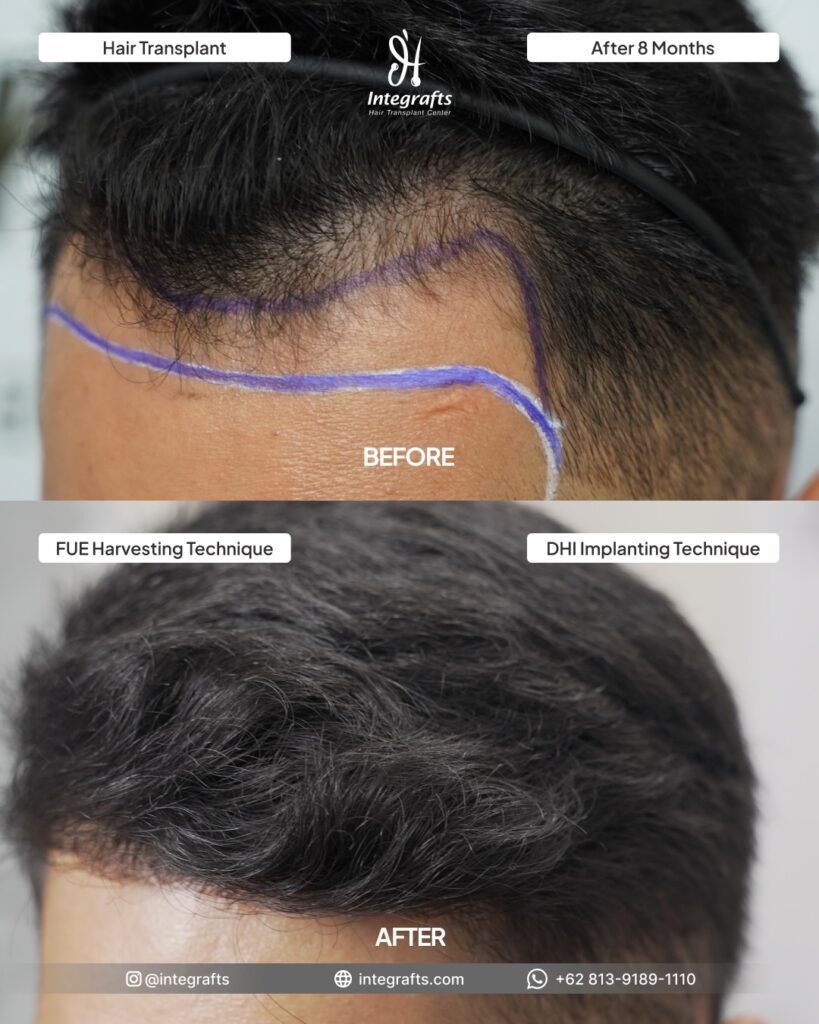 Before- After FUE dan DHI